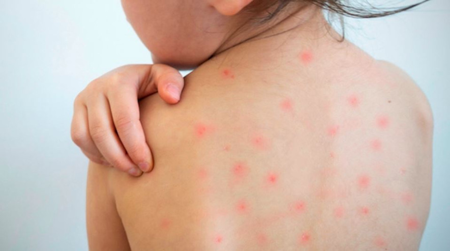 बाँकेमा दादुराको सङ्क्रमण कायमै