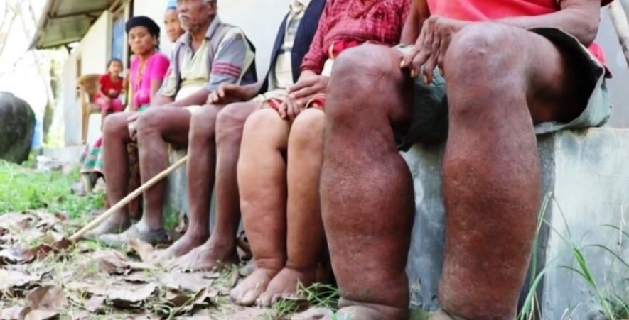 बाँकेमा हात्तीपाइले रोगको उच्च जोखिम