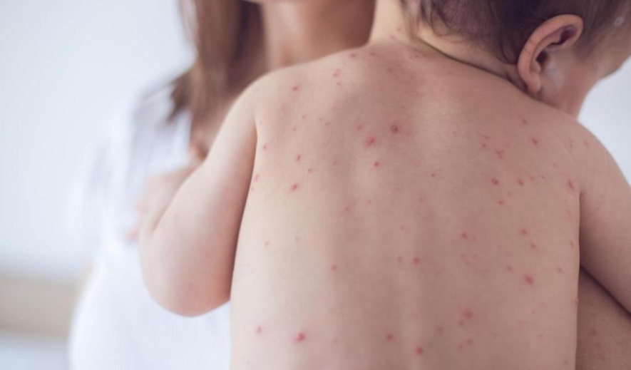 दादुरा प्रकोप क्षेत्रमा खोप नलगाएका बालबालिका भेटिए