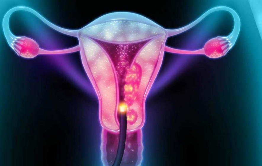 नरैनापुरमा १५४ महिलाको पाठेघर परीक्षण गर्दा ६ मा क्यान्सर