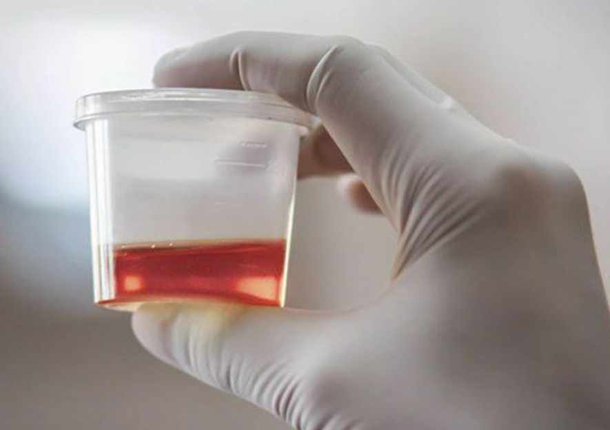 पिसाबमा रगत आउनु गम्भीर रोगको लक्षण !