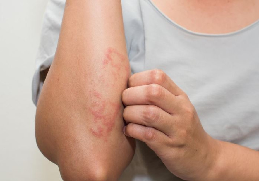 के हो छालाको समस्या ‘एक्जिमा’ ?