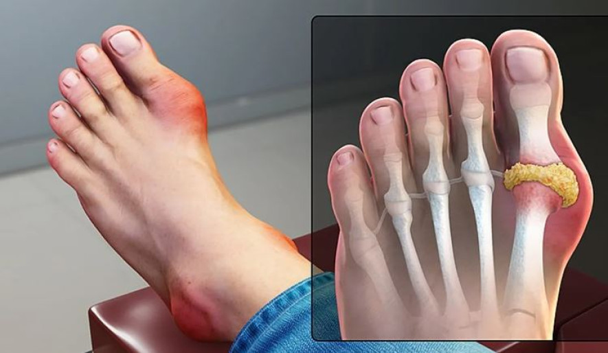 यूरिक एसिड बढ्यो, कसरी कम गर्ने ?